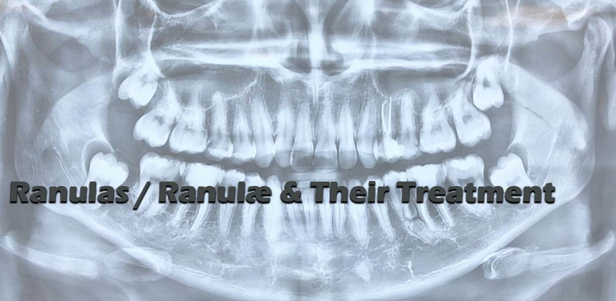 Ranulas / Ranulae & Their Treatment